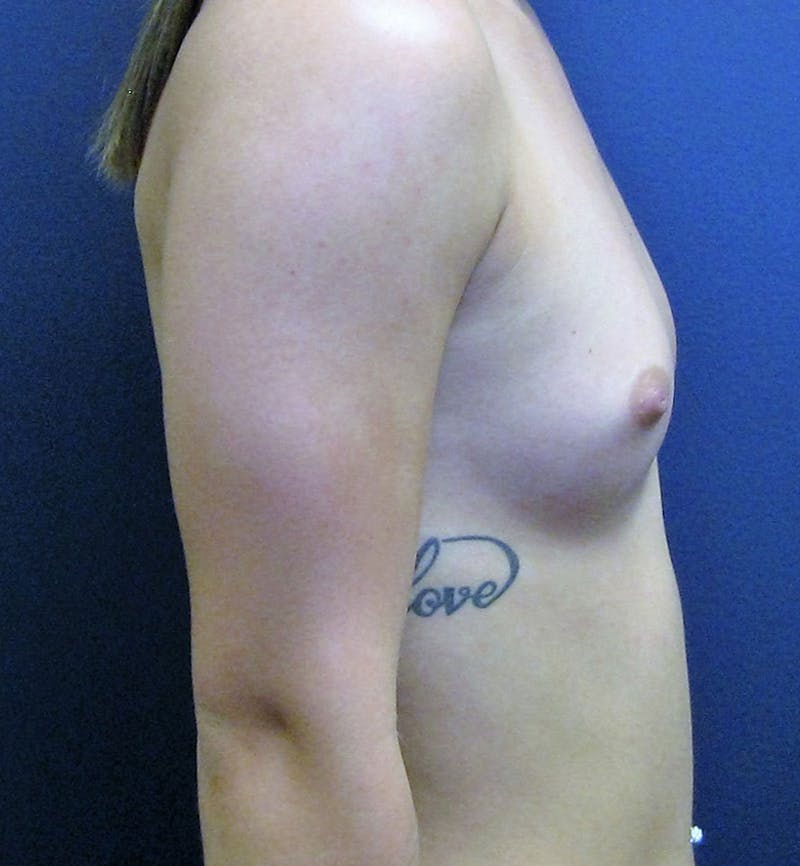 Breast Augmentation Before & After Gallery - Patient 402119 - Image 3