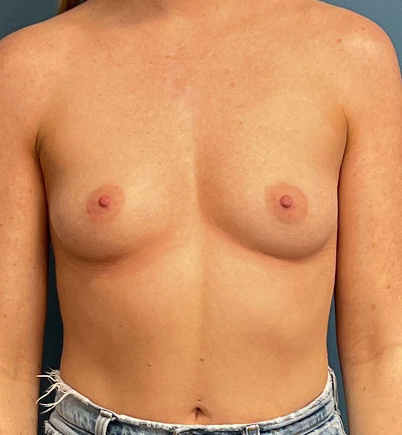 Breast Augmentation Before & After Gallery - Patient 209613 - Image 1