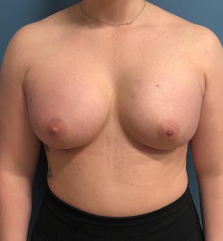 Breast Augmentation Before & After Gallery - Patient 204658 - Image 2