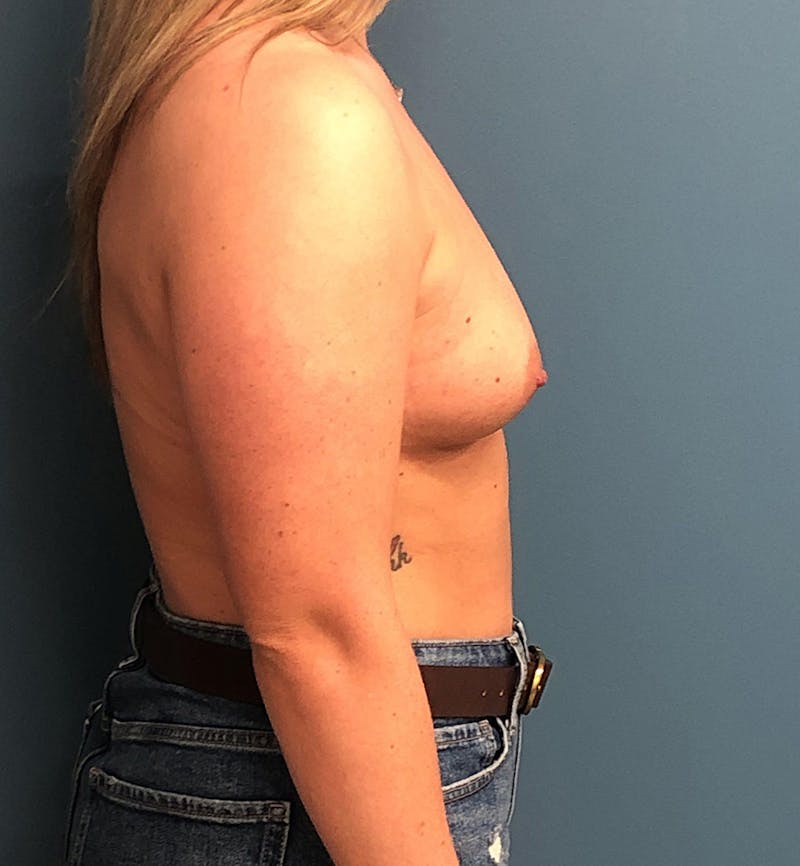 Breast Augmentation Before & After Gallery - Patient 204658 - Image 3