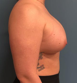 Breast Augmentation Before & After Gallery - Patient 204658 - Image 4