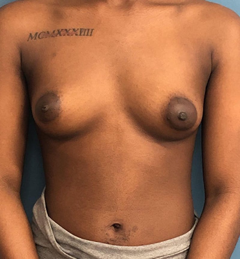 Breast Augmentation Before & After Gallery - Patient 165138 - Image 1