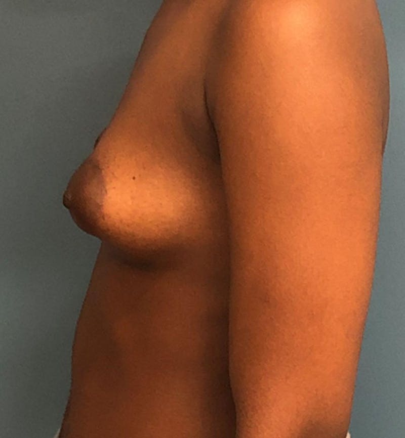 Breast Augmentation Before & After Gallery - Patient 165138 - Image 3