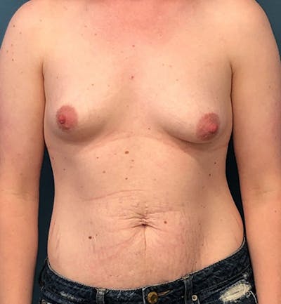 Breast Augmentation Before & After Gallery - Patient 278999 - Image 1