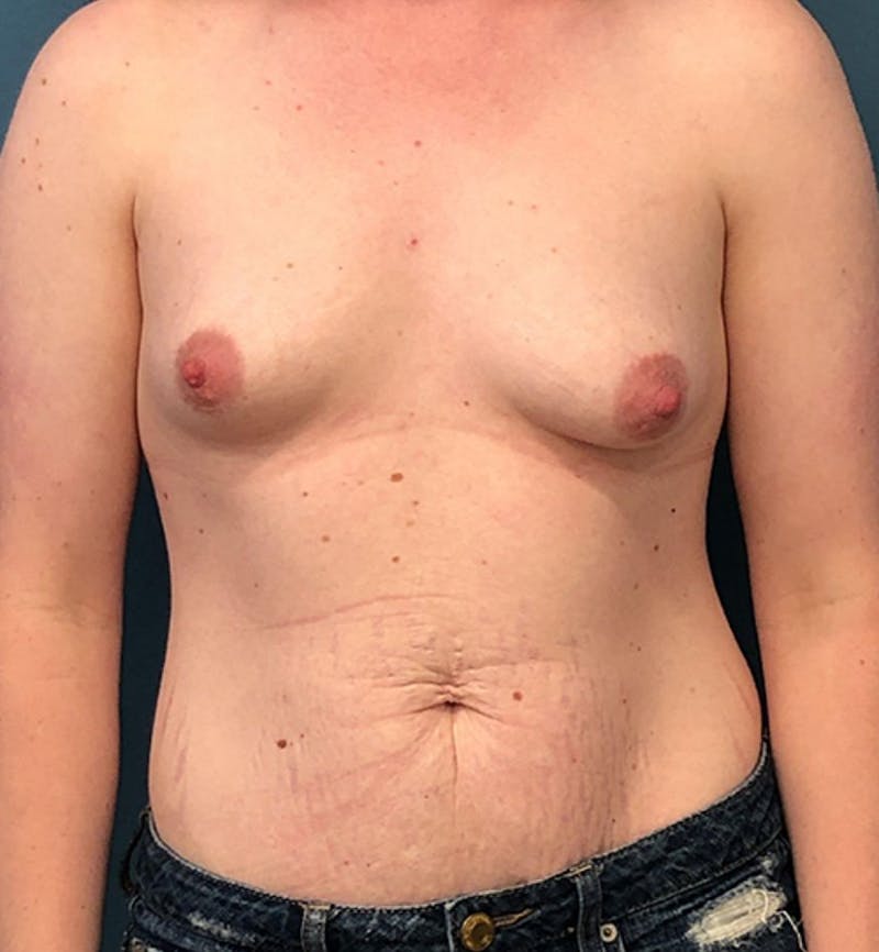 Breast Augmentation Before & After Gallery - Patient 278999 - Image 1