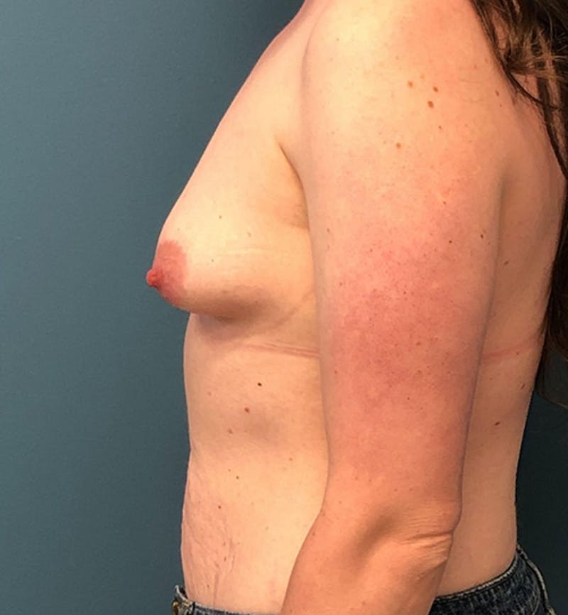 Breast Augmentation Before & After Gallery - Patient 278999 - Image 3