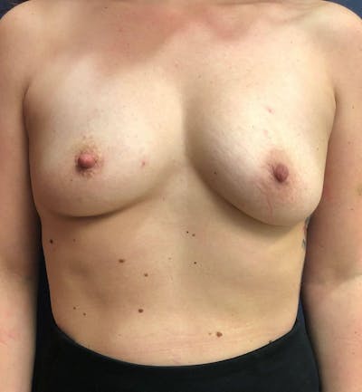Breast Augmentation Before & After Gallery - Patient 777027 - Image 1