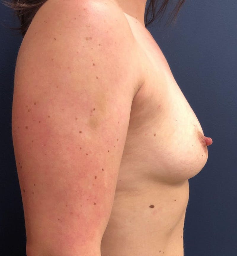 Breast Augmentation Before & After Gallery - Patient 777027 - Image 3
