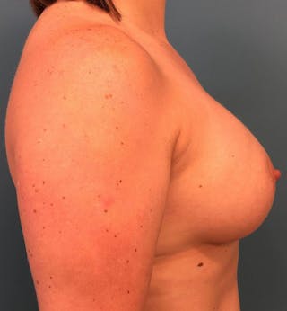 Breast Augmentation Before & After Gallery - Patient 777027 - Image 4