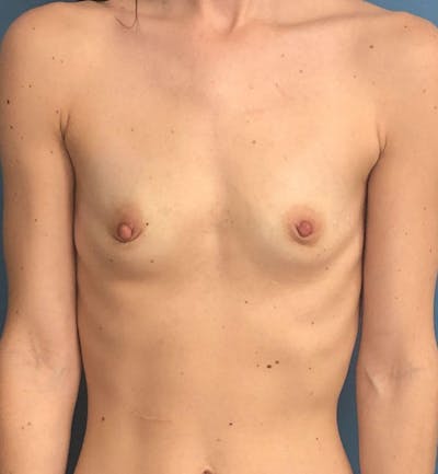 Breast Augmentation Before & After Gallery - Patient 289505 - Image 1