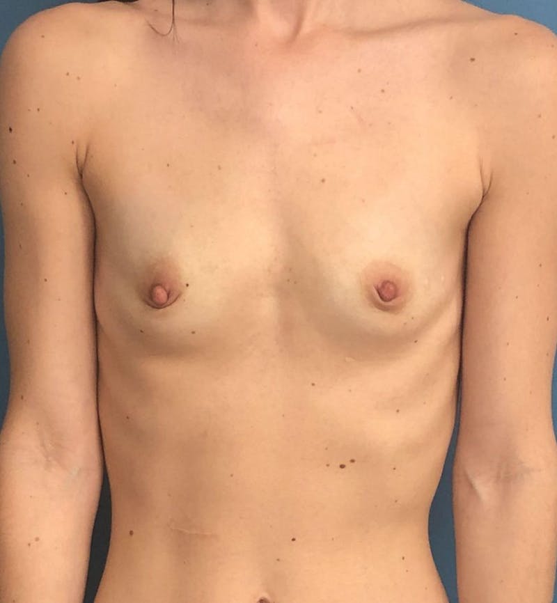 Breast Augmentation Before & After Gallery - Patient 289505 - Image 1