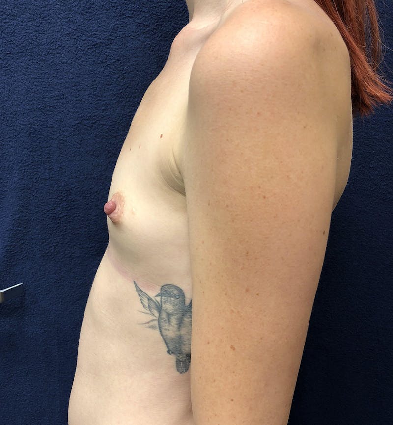 Breast Augmentation Before & After Gallery - Patient 856845 - Image 3