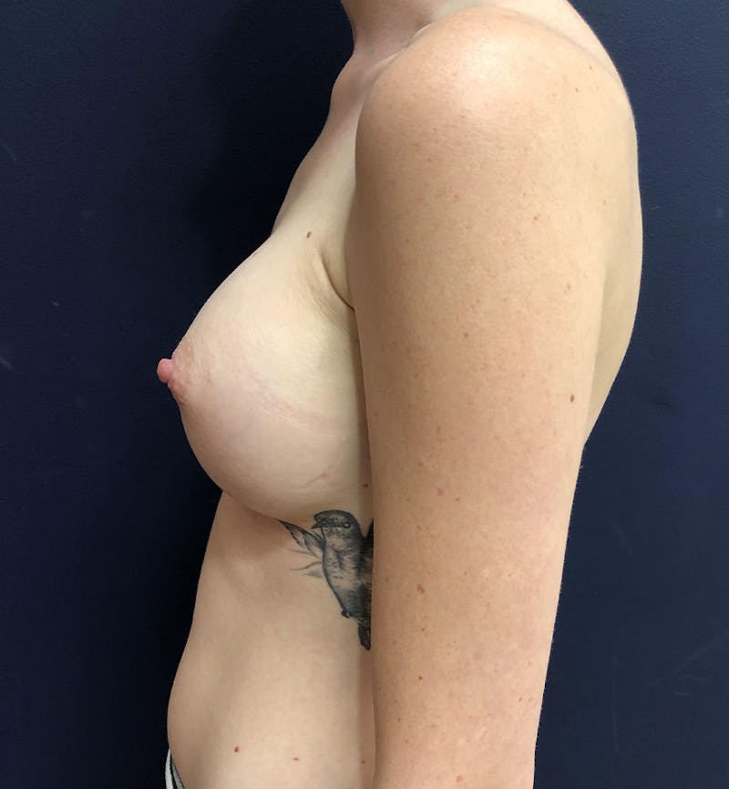 Breast Augmentation Before & After Gallery - Patient 856845 - Image 4
