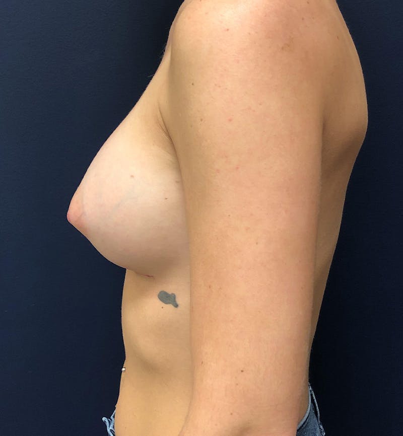 Breast Augmentation Before & After Gallery - Patient 265954 - Image 4