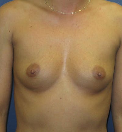 Breast Augmentation Before & After Gallery - Patient 299231 - Image 1