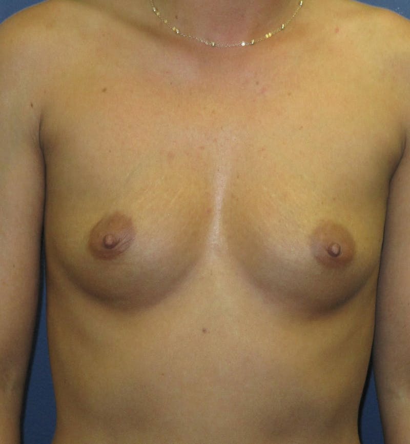Breast Augmentation Before & After Gallery - Patient 299231 - Image 1