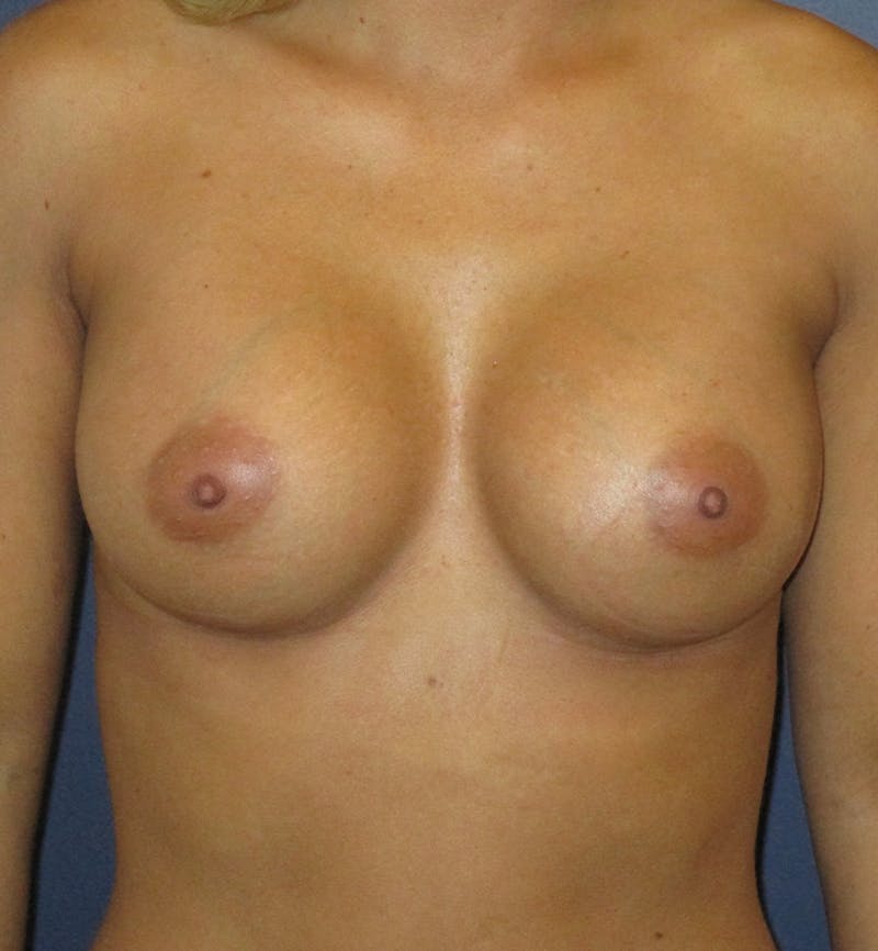 Breast Augmentation Before & After Gallery - Patient 299231 - Image 2