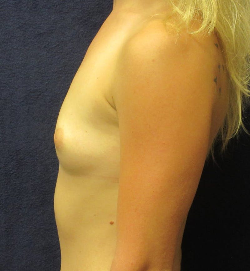 Breast Augmentation Before & After Gallery - Patient 400515 - Image 3