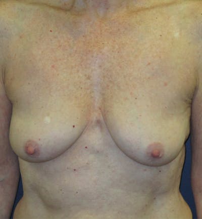 Breast Augmentation Before & After Gallery - Patient 422244 - Image 1