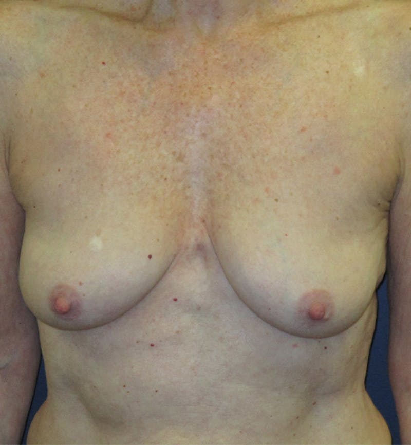 Breast Augmentation Before & After Gallery - Patient 422244 - Image 1