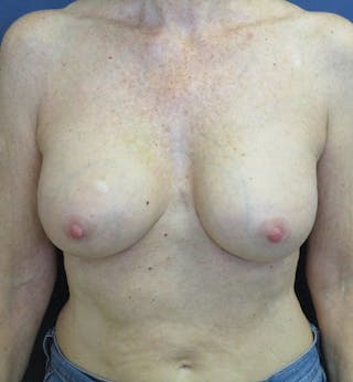 Breast Augmentation Before & After Gallery - Patient 422244 - Image 2