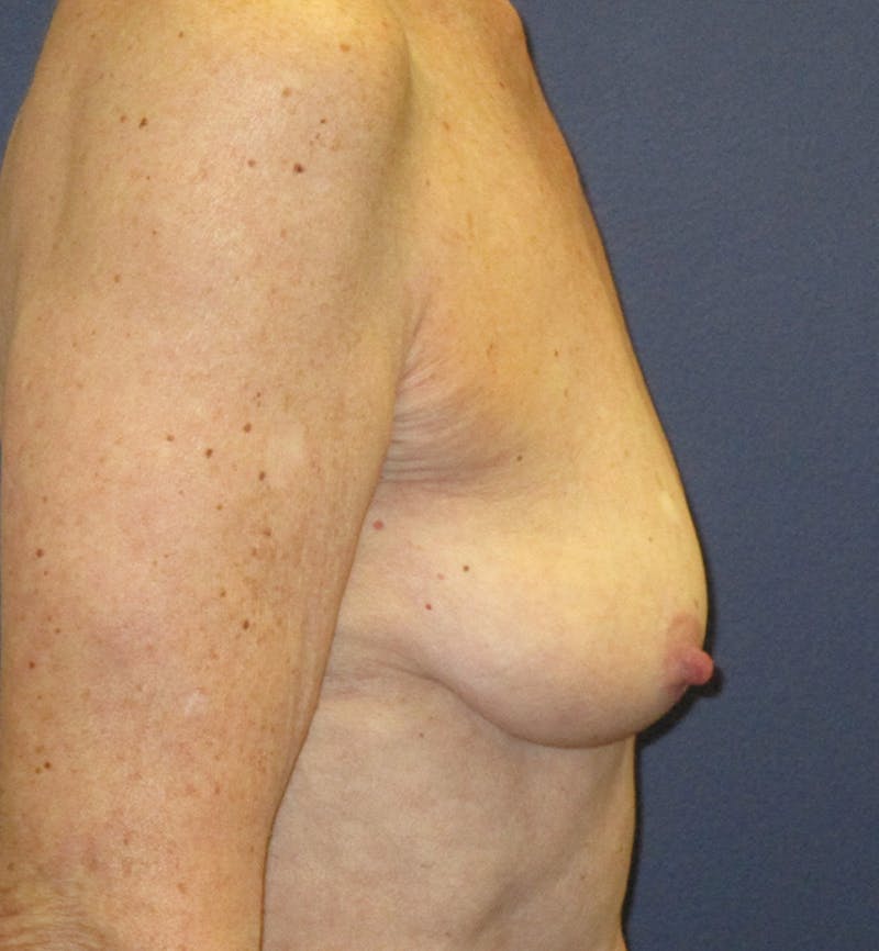 Breast Augmentation Before & After Gallery - Patient 422244 - Image 3