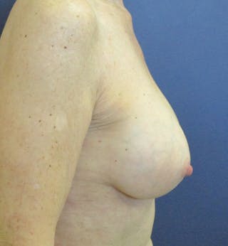 Breast Augmentation Before & After Gallery - Patient 422244 - Image 4