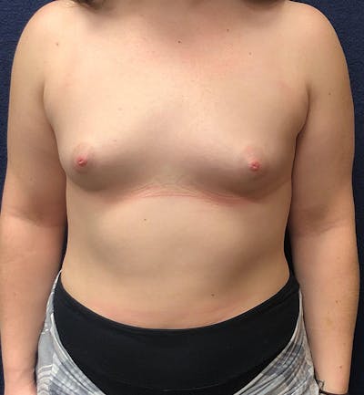 Breast Augmentation Before & After Gallery - Patient 337517 - Image 1