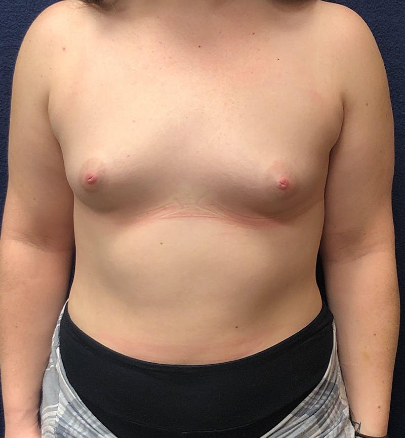 Breast Augmentation Before & After Gallery - Patient 337517 - Image 1