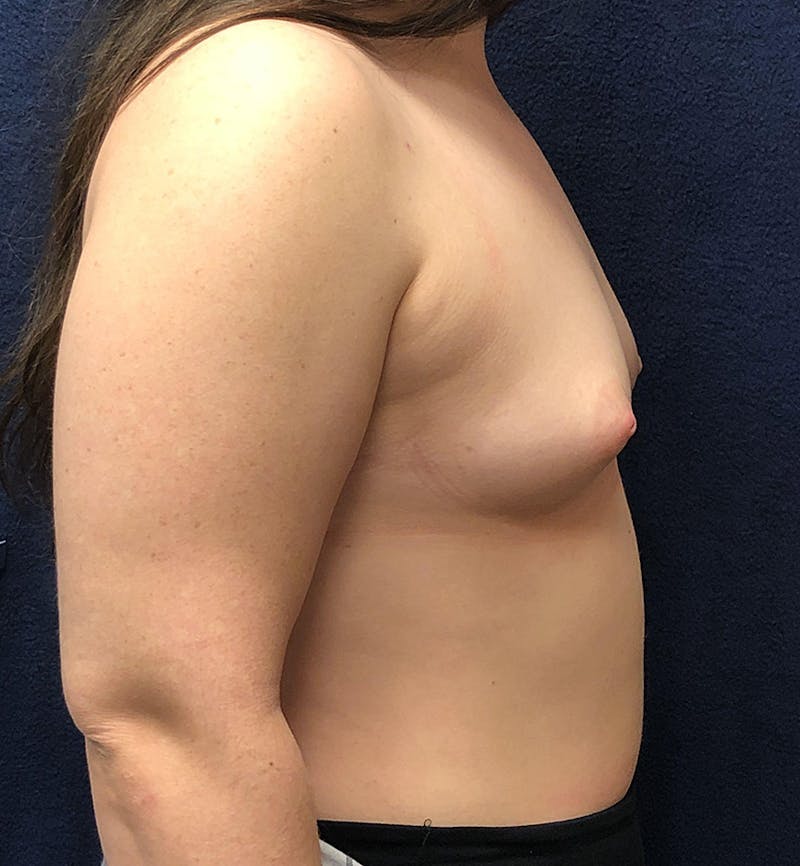 Breast Augmentation Before & After Gallery - Patient 337517 - Image 3