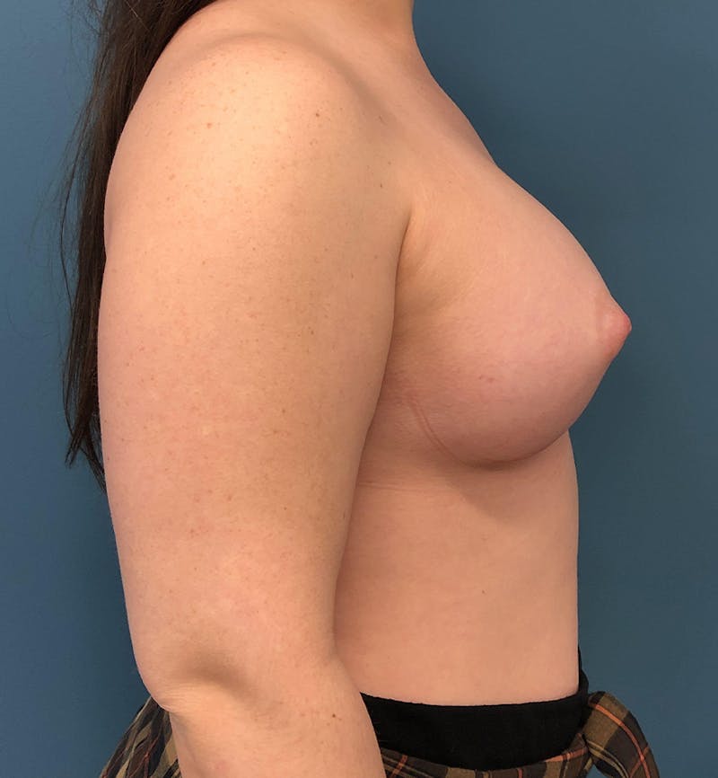 Breast Augmentation Before & After Gallery - Patient 337517 - Image 4