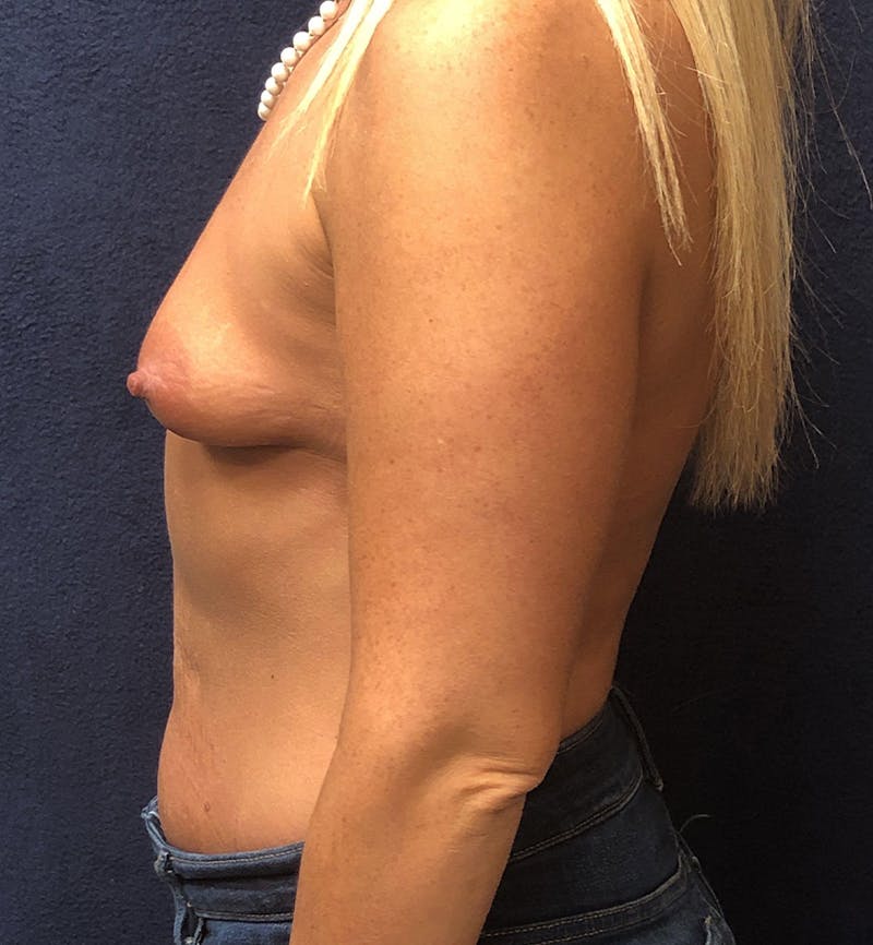 Breast Augmentation Before & After Gallery - Patient 303445 - Image 3