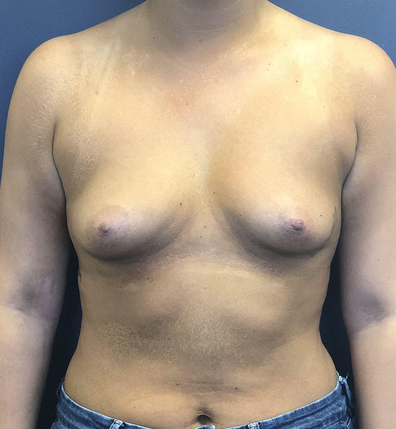 Breast Augmentation Before & After Gallery - Patient 150211 - Image 1