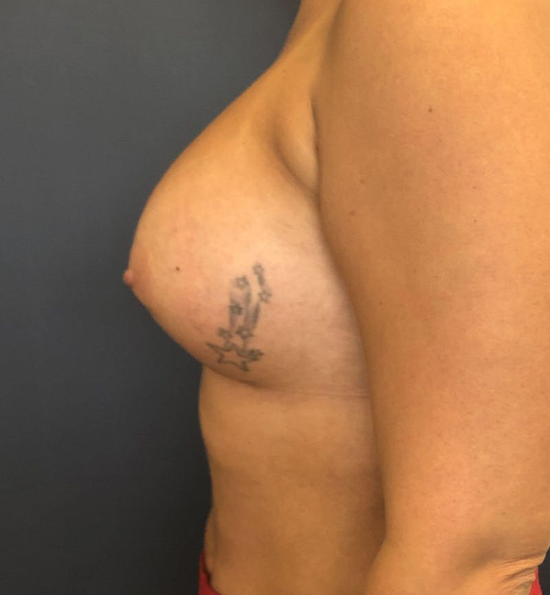 Breast Augmentation Before & After Gallery - Patient 150211 - Image 4