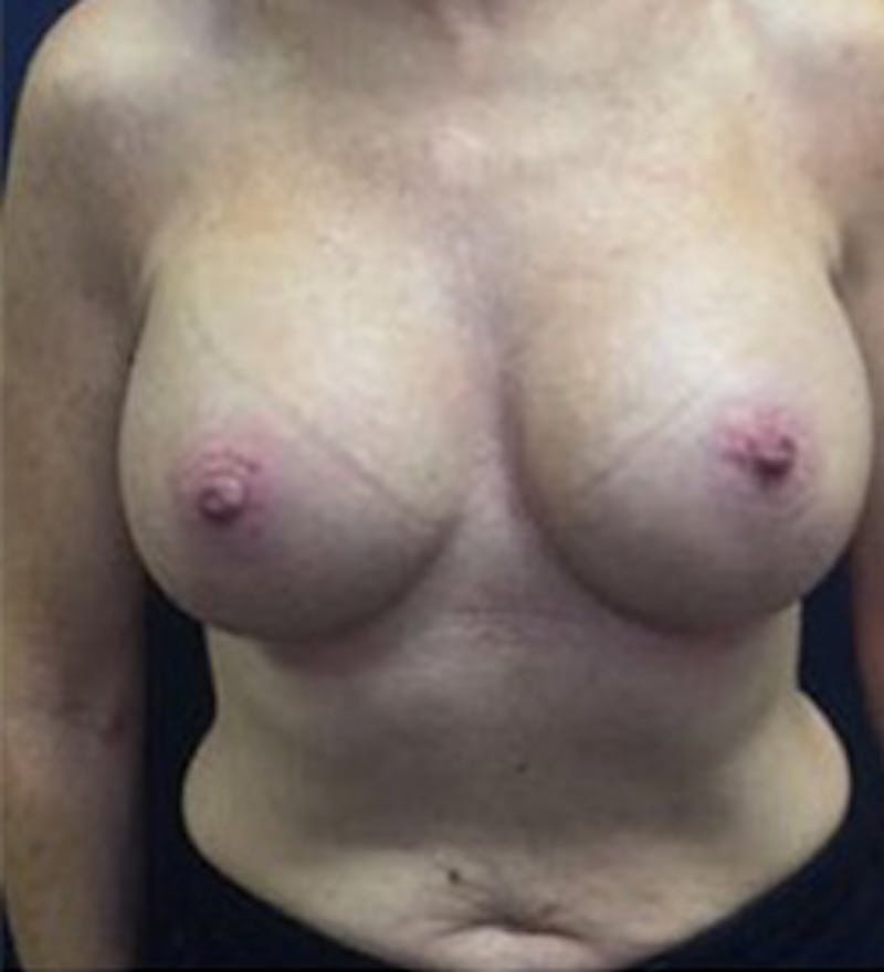 Breast Augmentation Before & After Gallery - Patient 331538 - Image 2