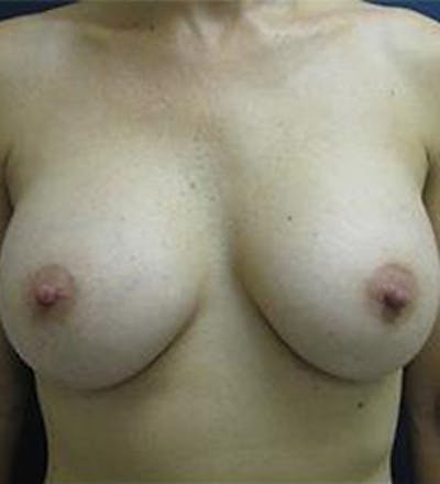 Breast Augmentation Before & After Gallery - Patient 335459 - Image 2