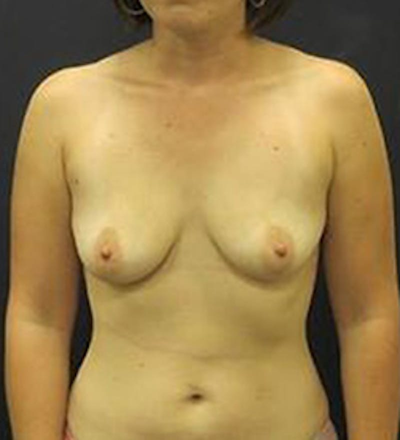 Breast Augmentation Before & After Gallery - Patient 308961 - Image 1