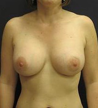 Breast Augmentation Before & After Gallery - Patient 308961 - Image 2