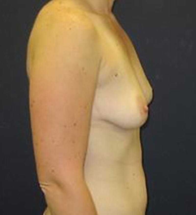 Breast Augmentation Before & After Gallery - Patient 308961 - Image 3