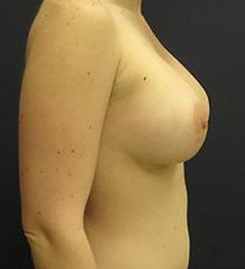 Breast Augmentation Before & After Gallery - Patient 308961 - Image 4