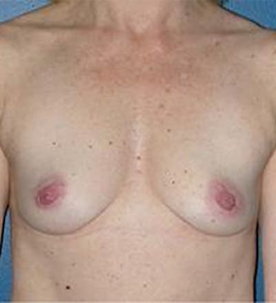 Breast Augmentation Before & After Gallery - Patient 594335 - Image 1