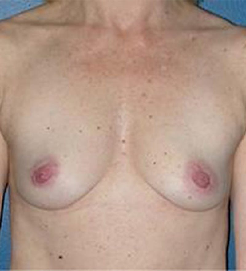 Breast Augmentation Before & After Gallery - Patient 594335 - Image 1