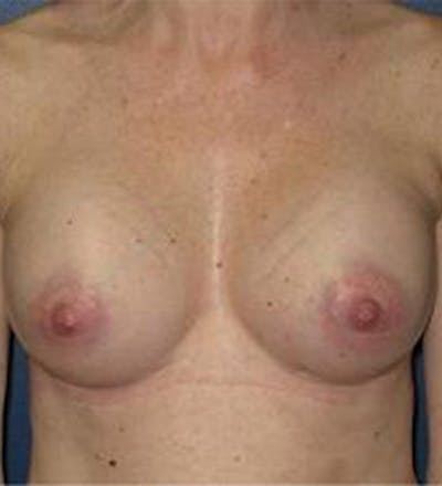 Breast Augmentation Before & After Gallery - Patient 594335 - Image 2
