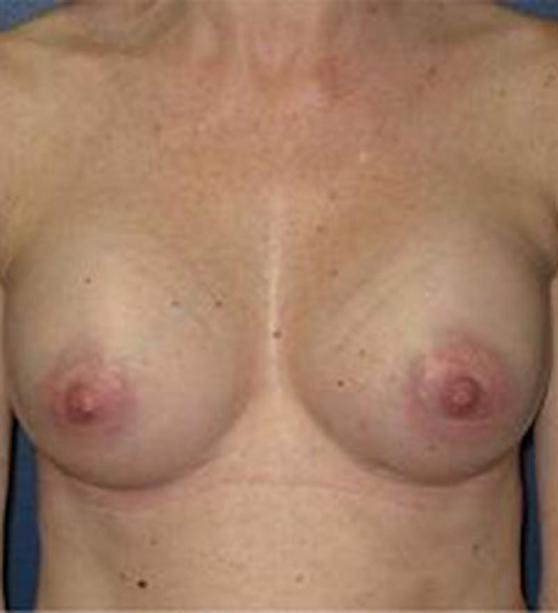 Breast Augmentation Before & After Gallery - Patient 594335 - Image 2