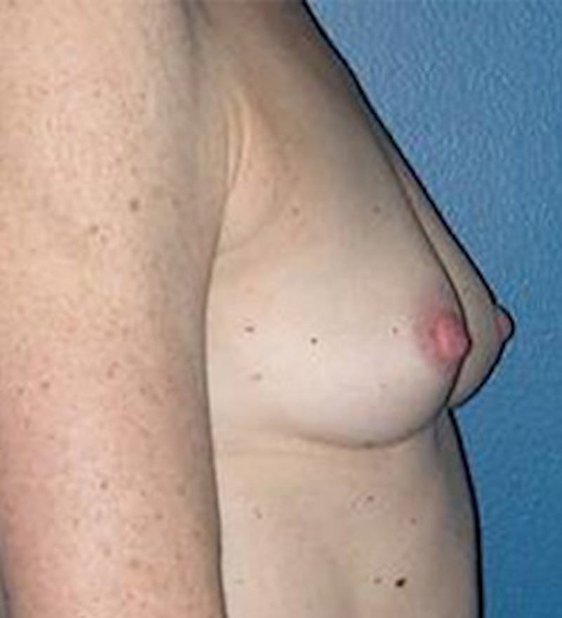 Breast Augmentation Before & After Gallery - Patient 594335 - Image 3