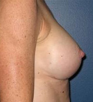 Breast Augmentation Before & After Gallery - Patient 594335 - Image 4