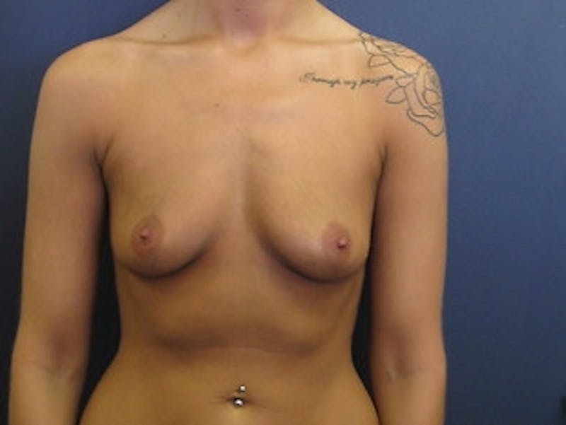 Breast Augmentation Before & After Gallery - Patient 200478 - Image 1
