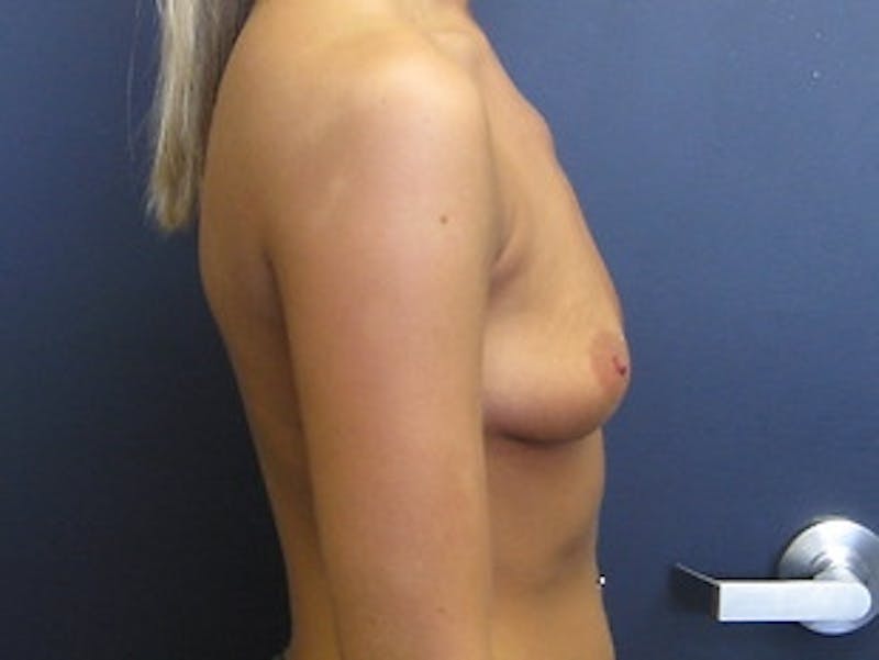 Breast Augmentation Before & After Gallery - Patient 200478 - Image 3