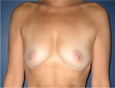 Breast Augmentation Before & After Gallery - Patient 989504 - Image 1