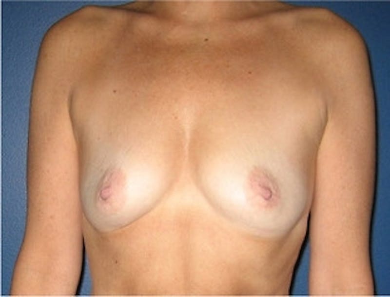 Breast Augmentation Before & After Gallery - Patient 989504 - Image 1